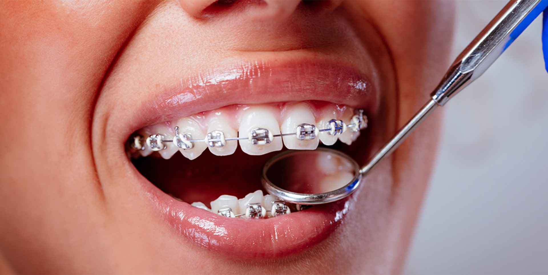 Dental Braces in Hathras