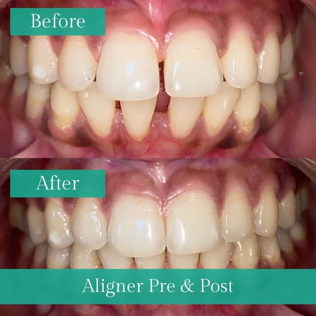 Teeth Aligners pre and post image